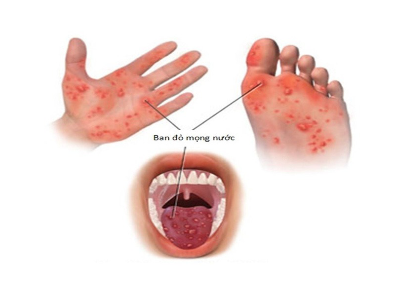 be-1-tuoi-mac-tay-chan-mieng-ton-thuong-nao-3-dau-hieu-som-bao-benh-nang