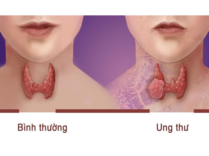bi-khan-tieng-co-gai-soc-khi-phat-hien-ung-thu-di-can-phoi