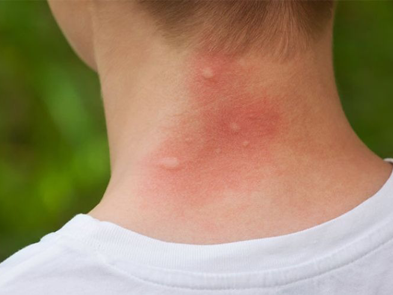 bi-quyet-tu-thien-nhien-tranh-mun-nhon-man-ngua-noi-me-day