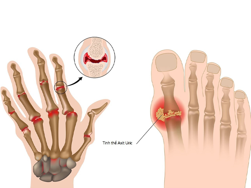 bonigut-bi-quyet-chien-thang-benh-gut-de-dang-cua-my