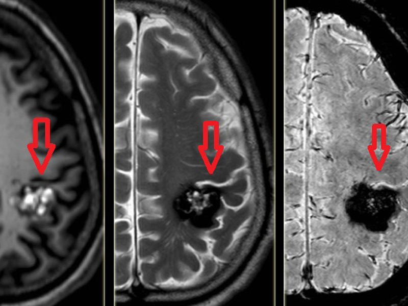 co-gai-liet-nua-nguoi-vi-dot-quy-bac-si-chi-3-nguyen-nhan-nguoi-tre-hay-mac