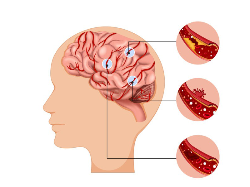 co-giao-34-tuoi-tu-vong-vi-dot-quy