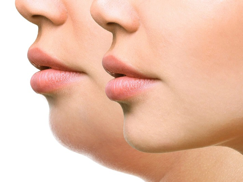 nen-don-cam-hay-tiem-filler