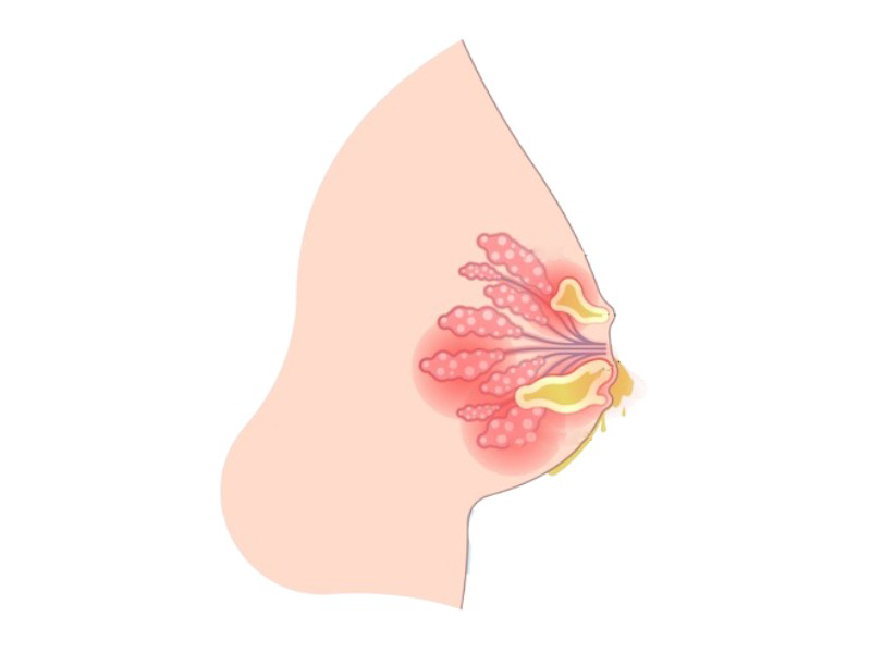 phu-nu-viet-bi-ung-thu-vu-ngay-cang-som-4-dau-hieu-de-nhan-biet