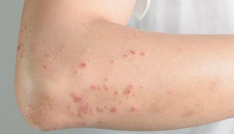 ban-soi-co-ngua-khong-dau-hieu-nhan-biet-cach-cham-soc-va-phong-ngua-hieu-qua