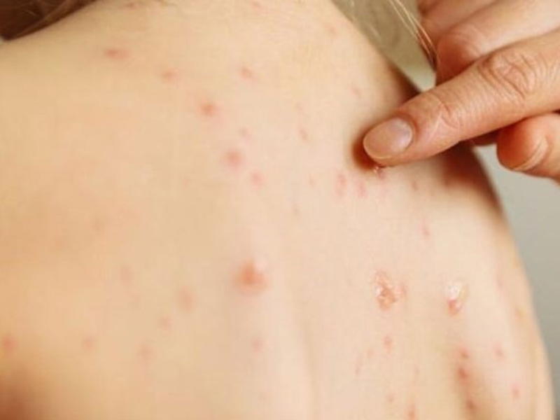 ban-soi-co-ngua-khong-dau-hieu-nhan-biet-cach-cham-soc-va-phong-ngua-hieu-qua