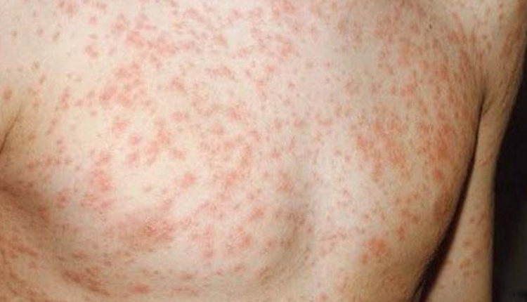 ban-soi-la-gi-dau-hieu-nhan-biet-nguyen-nhan-gay-benh-va-cach-phong-ngua-hieu-qua-cho-moi-lua-tuoi