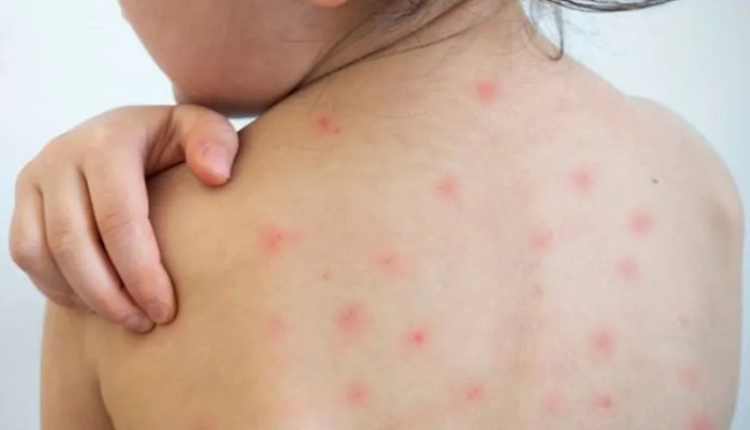 bệnh sởi ở trẻ em