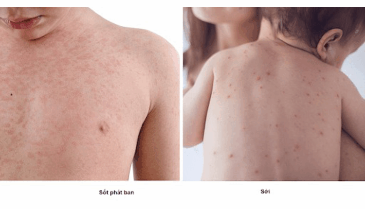 hieu-dung-ve-ban-soi-va-sot-phat-ban-cach-nhan-biet-phan-biet-va-phong-ngua-hieu-qua